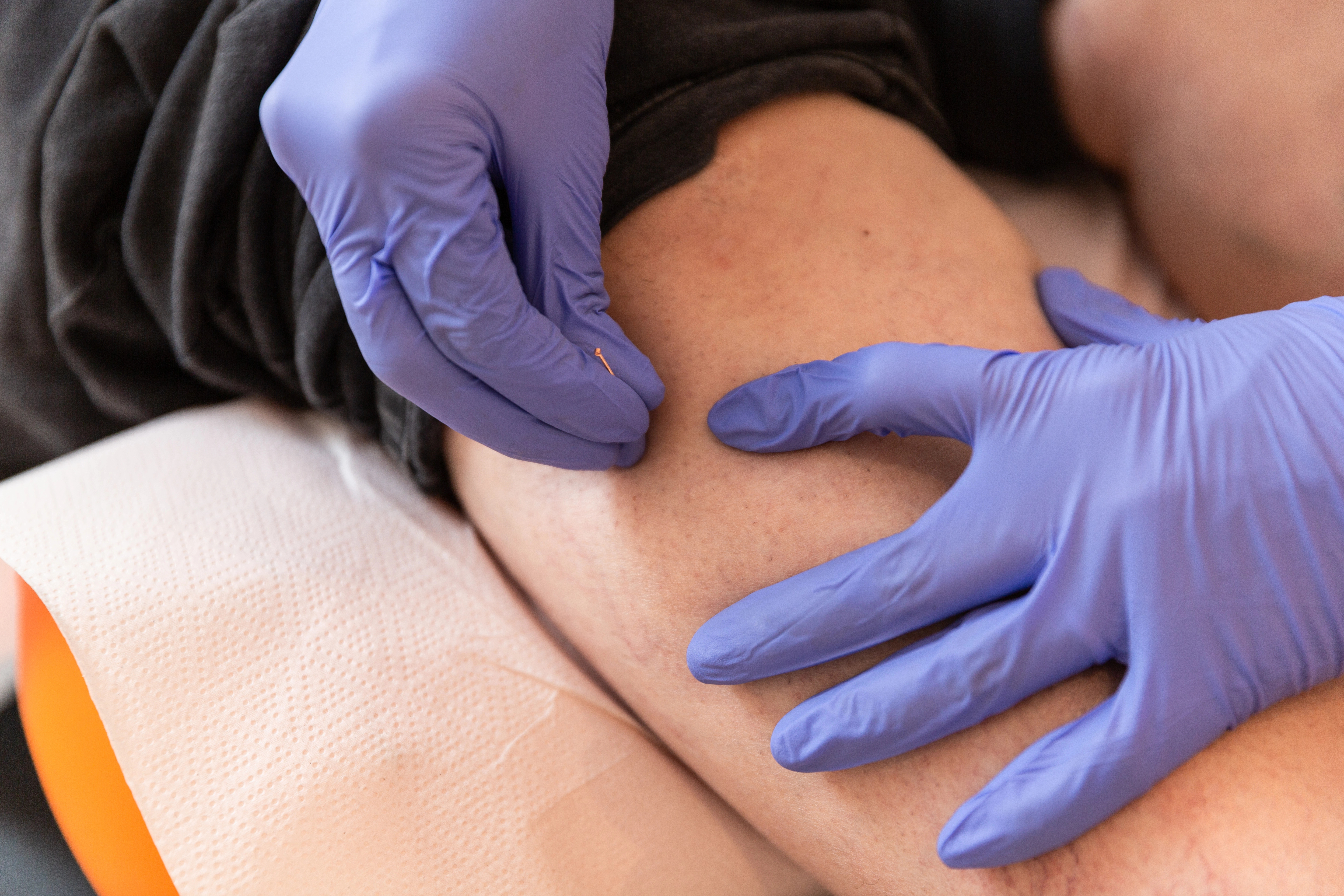Dry needling