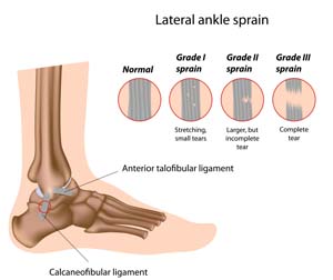 Images of lateral ankle sprain