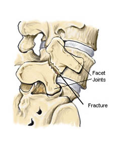 Image of lumbar stress fracture